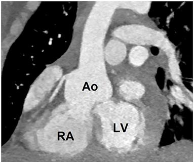 Case Report: Right Heart Failure Mistaken for Obesity—A Fault of Telemedicine